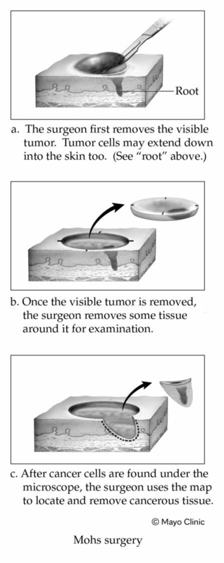 Mohs surgery illustration