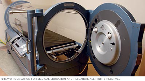 hyperbaric oxygen therapy