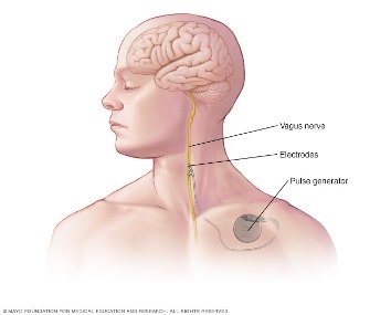 vagus nerve stimulator illustration