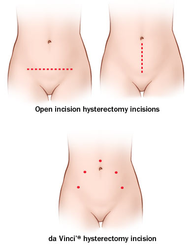 incisioncomparisonhyst2col