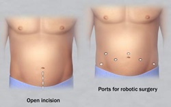 roboticprostatectomyincisions2col
