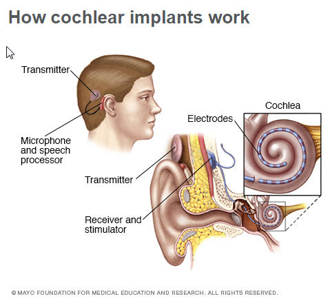 CochlearImplants