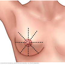 BreastSelfExam