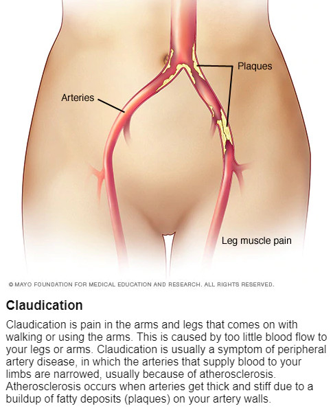 Peripheral Artery Disease