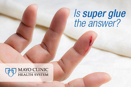 Should Super Glue Be In Your First Aid Kit Mayo Clinic Health Super Glue Be In Your First Aid Kit