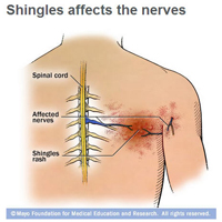 Shingles: Not just a band of blisters