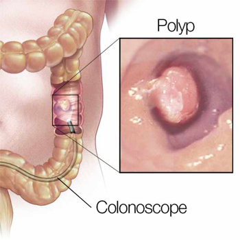 Colorectal Cancer_Large