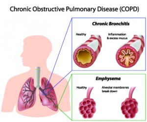 COPD