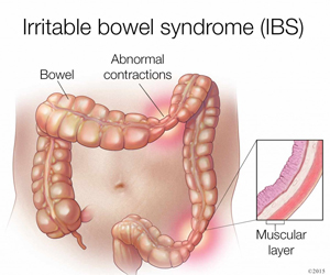 Lazy Bowel Syndrome: What Is It, Causes, Treatment, and More