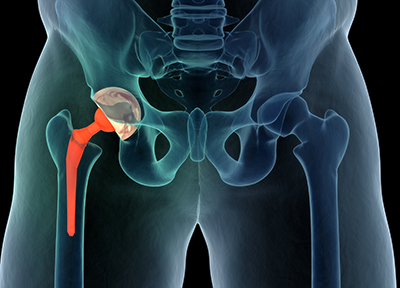 Should I have a hip replacement? - Mayo Clinic Health System