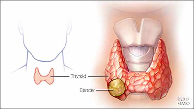 a-medical-illustration-of-thyroid-cancer