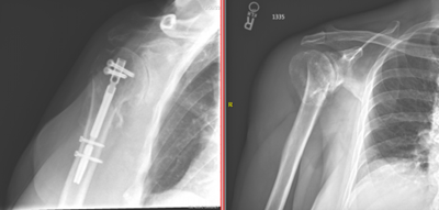 Anterior proximal humerus fracture X-ray