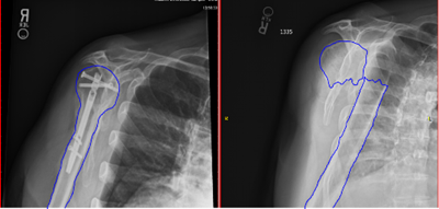 Lateral humerus fracture Xray