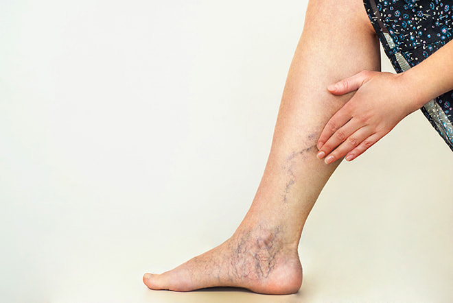 woman-touching-varicose-veins-on-leg
