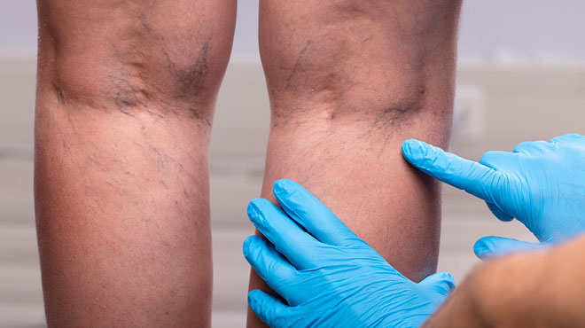 6 varicose vein myths debunked - Mayo Clinic Health System