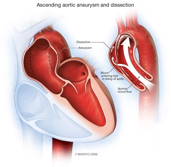 Aortic aneurysm illustration