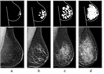 Breast density imaging categories