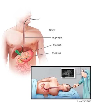 Endoscopic ultrasound pancreatic cancer