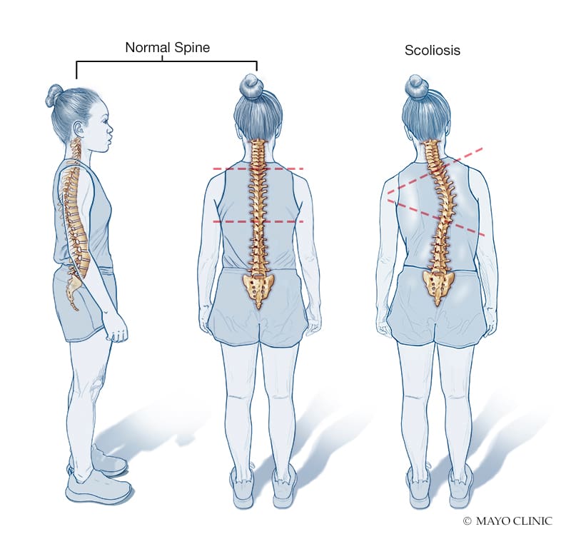 Scoliosis illustration