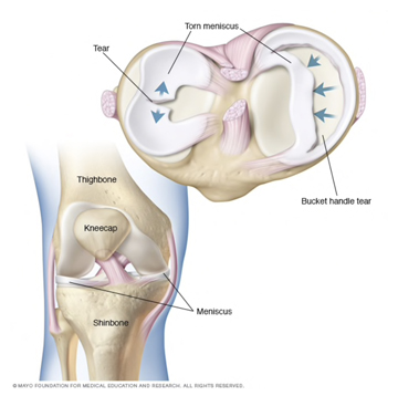 Torn meniscus illustration
