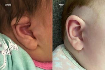 Before and after ear deformity