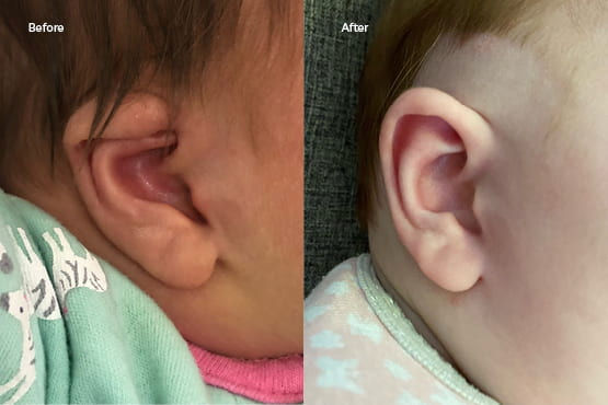 Before and after ear deformity