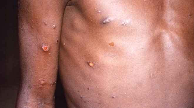 Monkeypox on torso and arm
