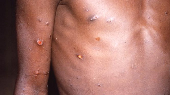 What You Need to Know About Monkeypox