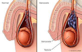 Scrotal varicocele illustration