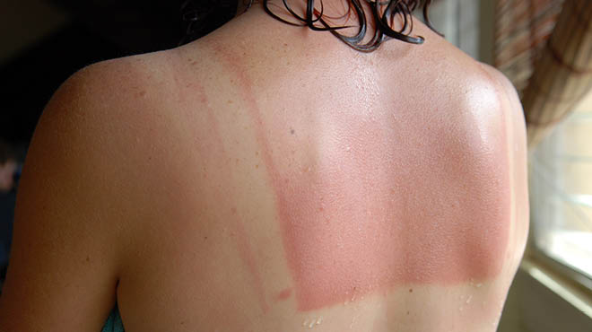 Sunburn: Symptoms & Treatment