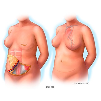 Breast reconstruction: Deep inferior epigastric perforation (DIEP) flap illustration