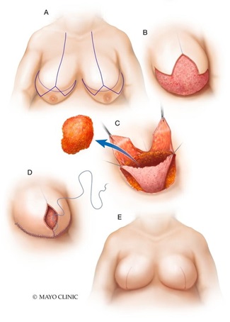 Breast reconstruction: Goldilocks procedure illustration