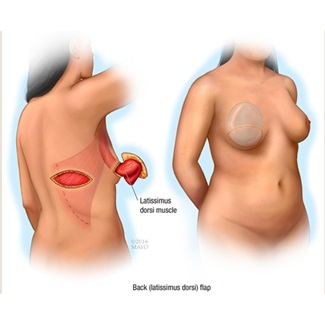 Breast reconstruction: latissimus dorsi flap illustration