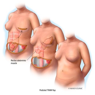 Breast reconstruction: pedicle TRAM flap illustration