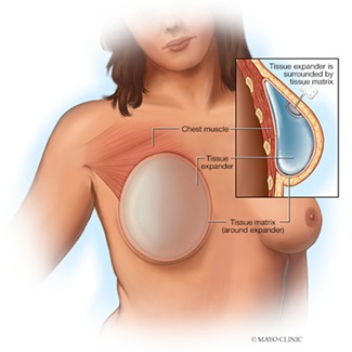 Breast tissue expansion and implant illustration