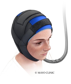 Cold cap scalp cooling therapy - Mayo Clinic Health System