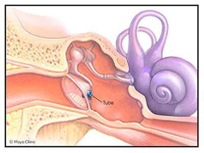 Ear tube illustration