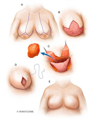 Goldlilocks procedure illustration