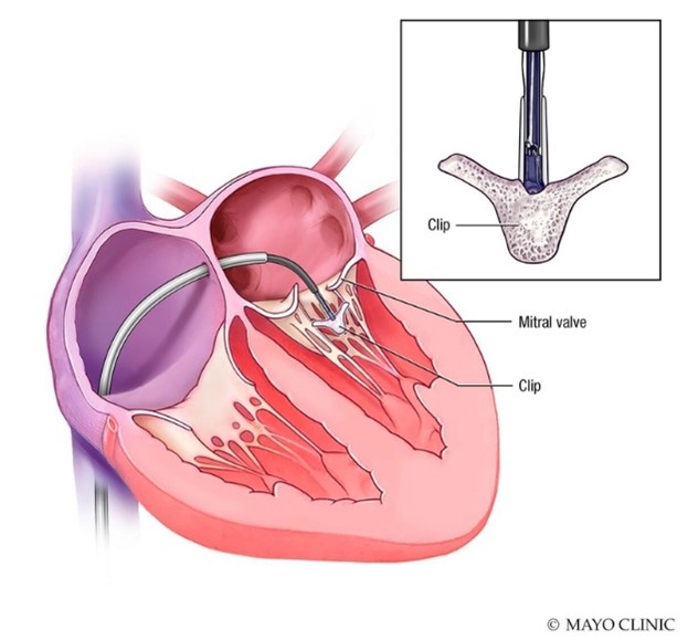 Mitral valve illustration