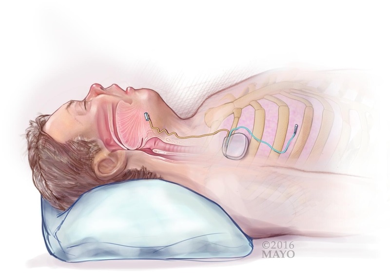 Nerve stimulator illustration