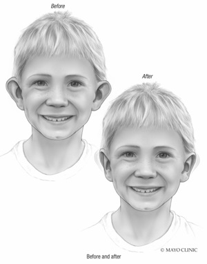 Otoplasty illustration