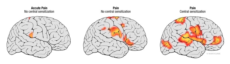 Pain pathways illustration