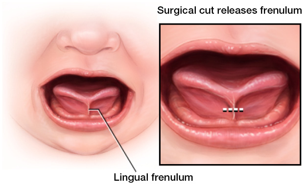 Tongue tie illustration