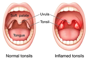 Tonsils illustration