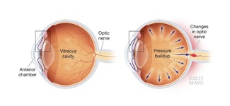 Glaucoma illustration