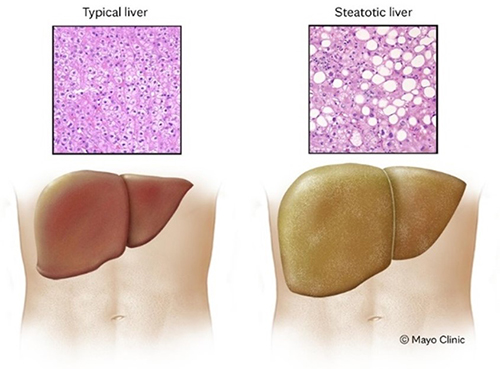 Illustration of a typical liver and fatty liver disease