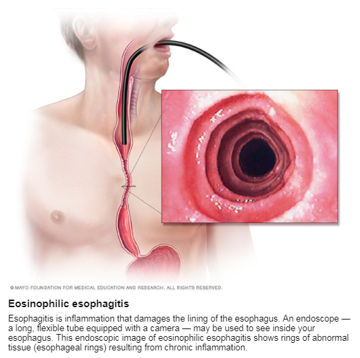 Esophagitis