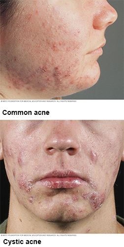 Common Acne and Cystic Acne