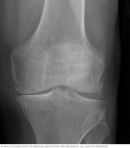 X-ray of knee arthritis