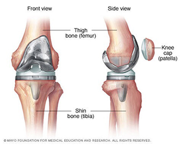 Knee Replacement Surgery